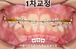 수술후