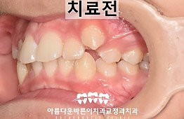 수술전