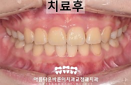 수술후