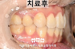 수술후