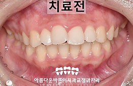 수술전