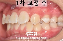 수술후