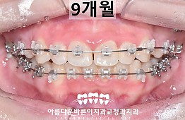 수술후