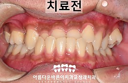 수술전