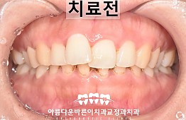 수술전
