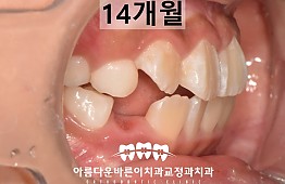 수술후