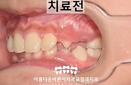 수술전