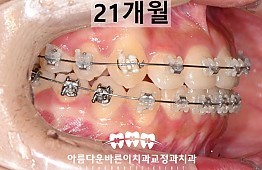 수술후
