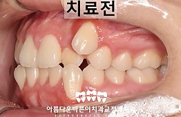 수술전