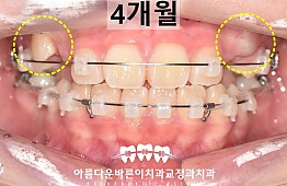 수술후