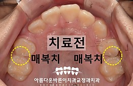 수술전