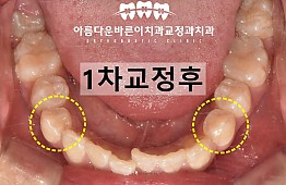 수술후
