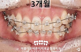 수술후