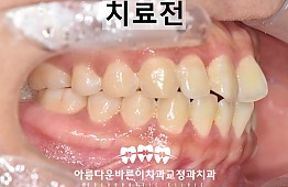 수술전