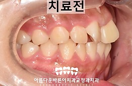 수술전
