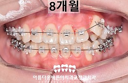 수술후