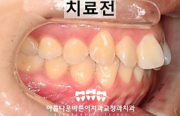 수술전