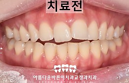 수술전