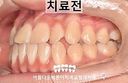 수술전