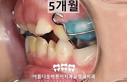수술후