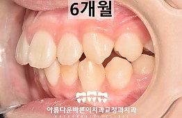 수술후