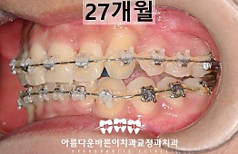 수술후