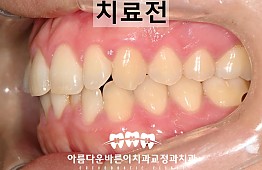 수술전