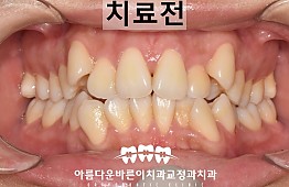 수술전