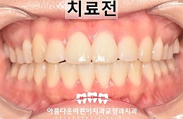 수술전