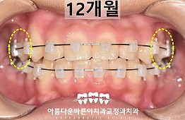 수술후