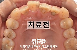 수술전