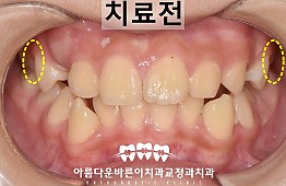 수술전