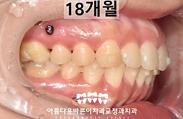 수술후