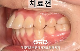 수술전