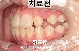 수술전