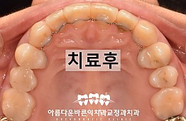 수술후