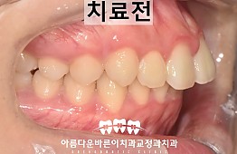 수술전