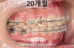 수술후