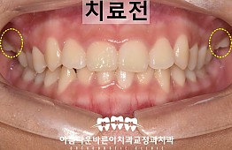 수술전