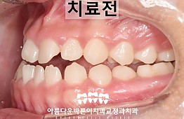 수술전