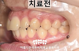 수술전