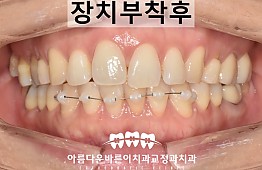 수술후