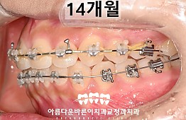 수술후