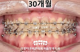 수술후