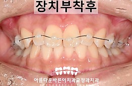 수술후