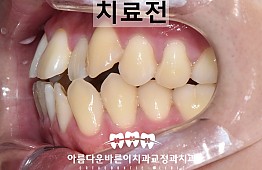 수술전