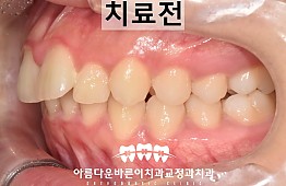 수술전