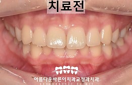 수술전