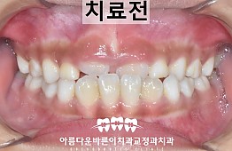 수술전