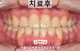 수술후